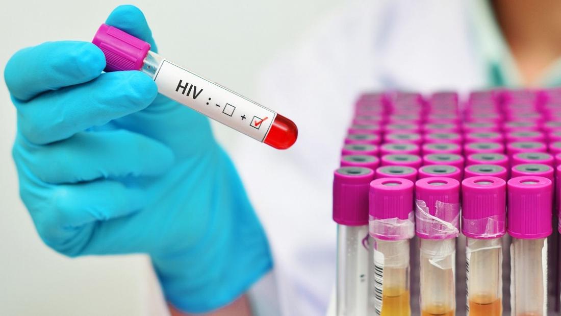 Another exceptionally harmful strain of HIV has been found in the Netherlands by specialists at Oxford University.