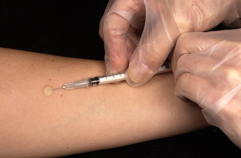 why does intradermal injections sting