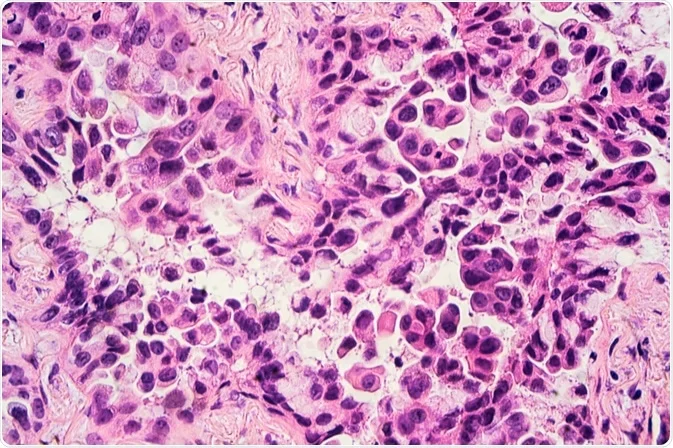  Non-Small Cell Lung Cancer