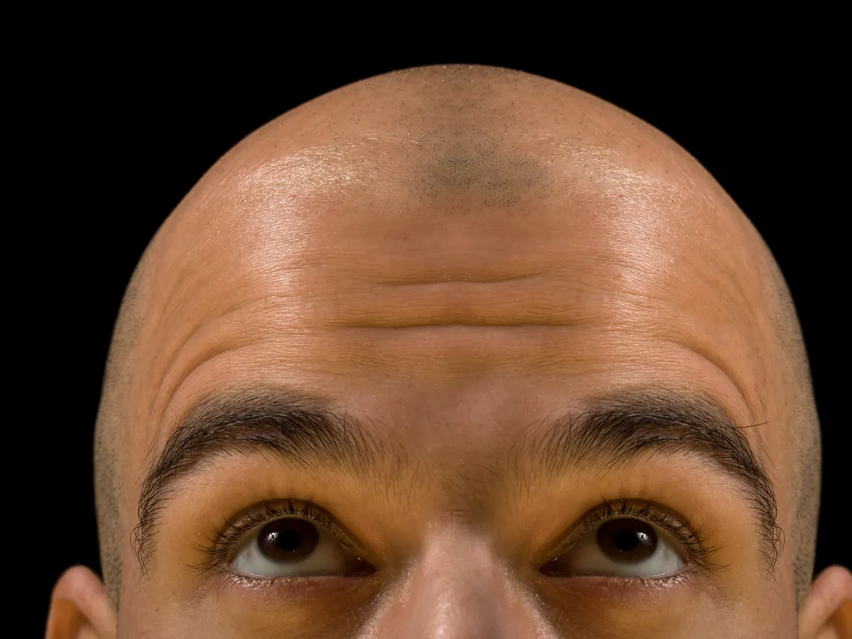 baldness