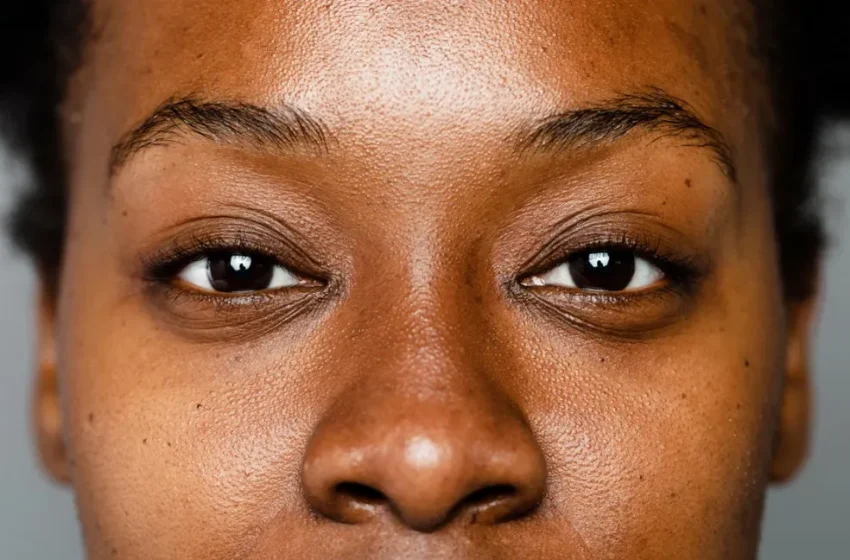  How to get rid of Brown skin pigmentation