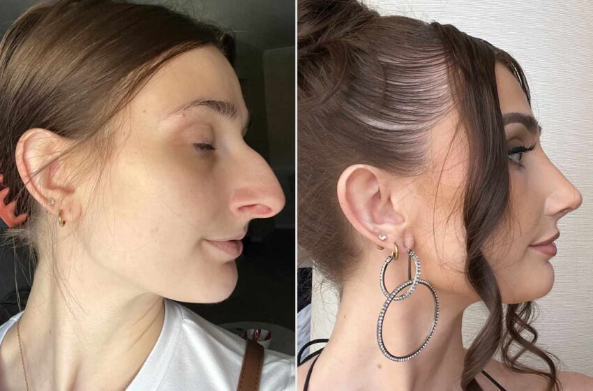  Devyn Aiken Spent Over 10 Years Saving $11K for a Nose Job